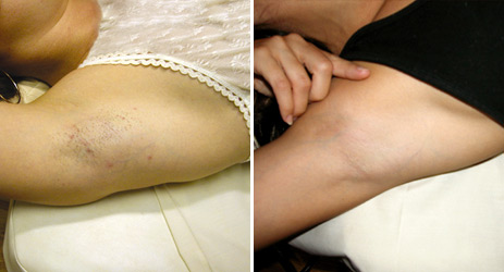 Hair Removal of woman's underarms