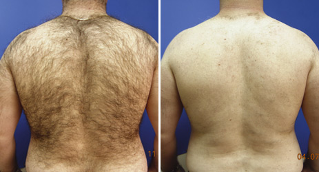 Hair Removal on man's back